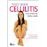 Todo sobre celulitis