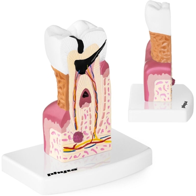 Modello Anatomico Dente Molare Malato 3D Studi Dentistici Odontoiatria Plastica - PHYSA